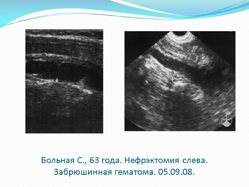 Больная С., 63 года. Нефрэктомия слева. Забрюшинная гематома. 05.09.08.